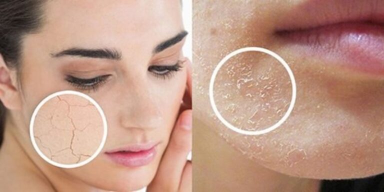 Những dấu hiệu cho thấy làn da đang bị thiếu ẩm