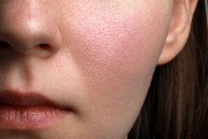 Những dấu hiệu cho thấy làn da đang bị thiếu ẩm